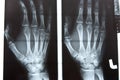 Human left hand xray image Royalty Free Stock Photo