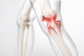 Human leg, knee meniscus, medically accurate representation of an arthritic knee joint