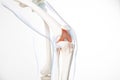 Human leg, knee meniscus, medically accurate representation of an arthritic knee joint