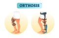 Human leg orthosis medical equipment vector illustration. Royalty Free Stock Photo