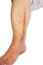 Human leg with postoperative scar of cardiac surgery Royalty Free Stock Photo