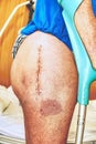 Human leg with postoperative scar of joint surgery. Detail of skin