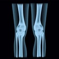 Human legs in x-rays. Knee joints.