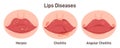 Human lips disease. Herpes, cheilitis and angular cheilitis. Sores, inflammation Royalty Free Stock Photo