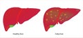Healthy liver and fatty liver Royalty Free Stock Photo