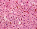 Human liver. Cholestasis