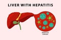 human liver hepatitis infection illustration