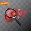 Human liver under a magnifying glass with viral cells. Vector medical illustration of finding virus or search in the internal