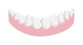 Human lower jaw gum with crooked teeth isolated