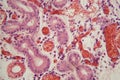 Human lung tissue with Pulmonary embolism under a microscope