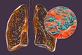 Human lungs affected by miliary tuberculosis, and close-up view of Mycobacterium tuberculosis, 3D illustration