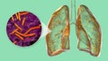 Human lungs affected by miliary tuberculosis, and close-up view of Mycobacterium tuberculosis, 3D illustration