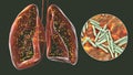 Human lungs affected by miliary tuberculosis, and close-up view of Mycobacterium tuberculosis, 3D illustration