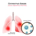 Human lungs are attacked by coronavirus Royalty Free Stock Photo