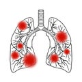 Human lungs in detail. anatomy. eps10 vector stock illustration. hand drawing. Affected by infection. Coronavirus