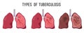 Human lungs infected Mycobacterium tuberculosis.