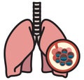 Human Lungs - PULMONARY EDEMA - Illustration