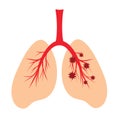 Human lungs, schematic illustration of human lungs infection with a virus. Anatomical structure of the human respiratory system. Royalty Free Stock Photo