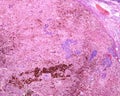 Human lymph node. Metastasis of malignant melanoma