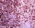 Human lymph node. Metastasis of malignant melanoma
