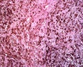 Human lymph node. Metastasis of malignant melanoma