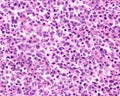 Human lymph node. Reticulosarcoma