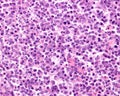 Human lymph node. Reticulosarcoma