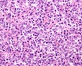 Human lymph node. Reticulosarcoma