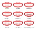 Human mouth jaws medical bad bite and healthy scheme with names set vector flat