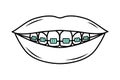 Human mouth with teeth in braces in doodle style. Corrective Orthodontics