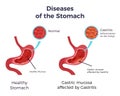 Human normal stomach compared to gastritis affected swollen inflamed mucosa lining flat set infographic poster illustration