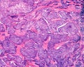 Human ovary carcinoma Royalty Free Stock Photo