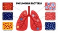 Pneumonia Bacteria Lungs Collection