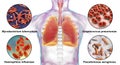 Human respiratory pathogens