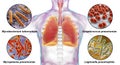 Human respiratory pathogens