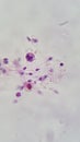 Human semen sample show Spermatozoon and white blood cell, posible semen infection