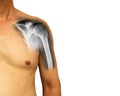 Human shoulder with x-ray show fracture at neck of humerus Arm bone . Isolated background . Blank area at right side