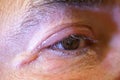 Human sick with eye conjunctivitis