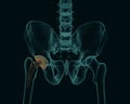 Human skeleton with a metal hip prosthesis concept arthroplasty