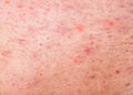 Human skin with acne Royalty Free Stock Photo