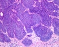 Human skin. Basal cell carcinoma