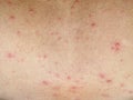 Human skin with chicken pox disease, varicella virus on young boy body, bubble rash texture Royalty Free Stock Photo