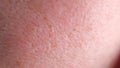 Human skin. Close up. common skin diseases include: Acne, blocked skin follicles that lead to oil, bacteria and dead Royalty Free Stock Photo