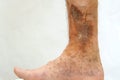 Human skin disease. Person s foot that is affected by dermatological skin disease with scars, ulcers and pigment spots. Perhaps Royalty Free Stock Photo