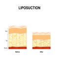 Human Skin layer before lipo and after Liposuction.
