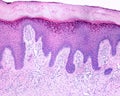 Human skin. Lichen planus