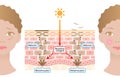 Human skin mechanism of melanin and facial dark spots. Infographic skin layer illustration. Beauty and skin care concept