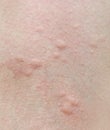 Human skin, presenting an allergic reaction