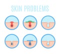 Human skin problems. Acne, black head pores and skin infections flat vector infographic illustration set Royalty Free Stock Photo