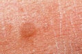 Human skin texture. Flat wart on skin micro photo. close up photo Royalty Free Stock Photo